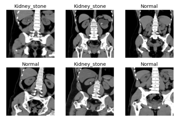 Kidney stone detection main sample images