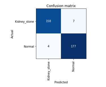 Kidney stone detection main