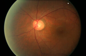 retinal-pigmentosa