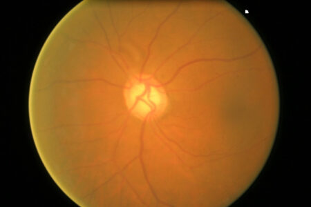 detection-of-retinal-pigmentosa